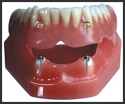 Kivehető rögzített fogsor implantátum